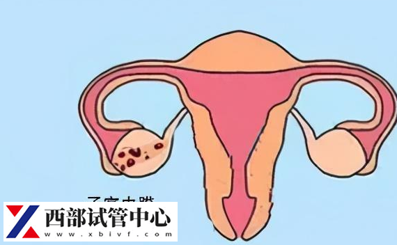 子宮內膜異位癥是婦科疾病