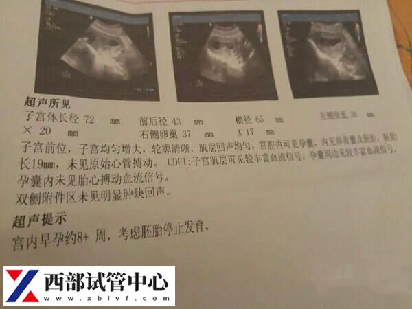 試管怎么預防胎停育